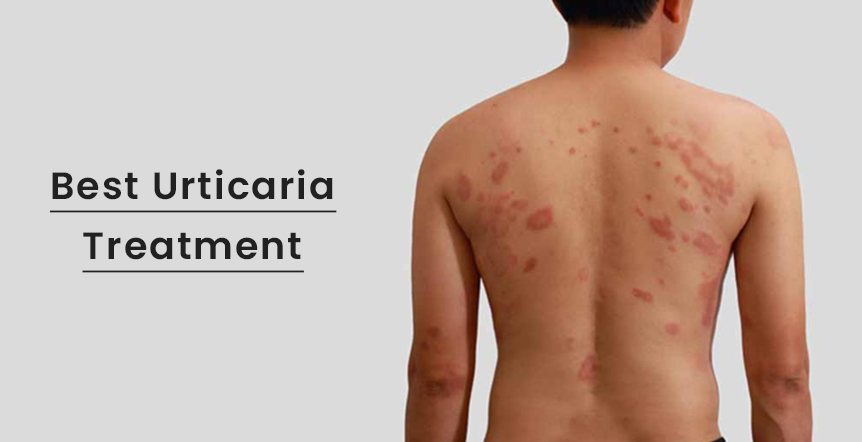 Best Urticaria Treatment